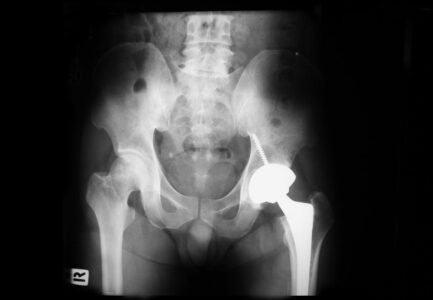 hip injury