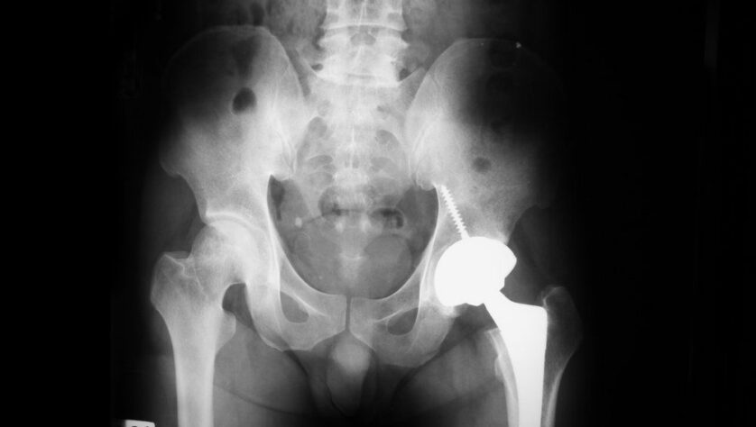 hip injury